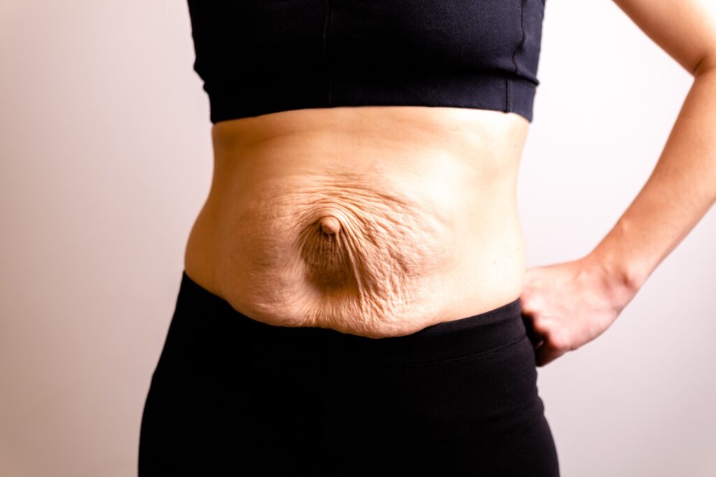 cropped woman dressed in black top and black leggings.Diastasis and umbilical hernia after pregnancy
