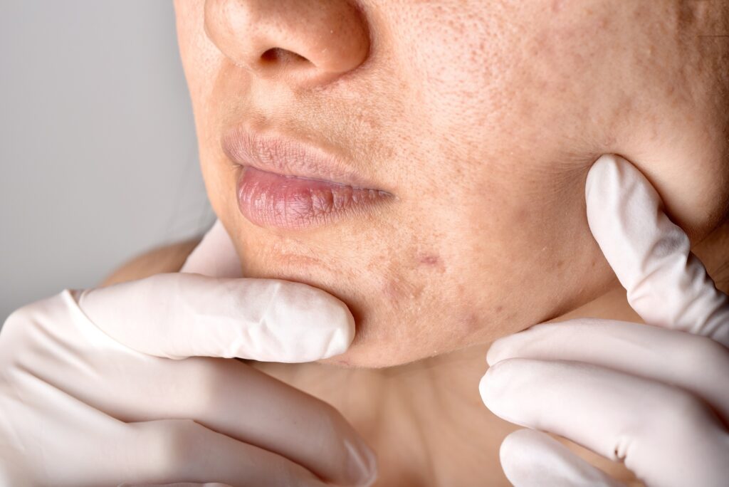 Doctor or Dermatologist hand exam patient face