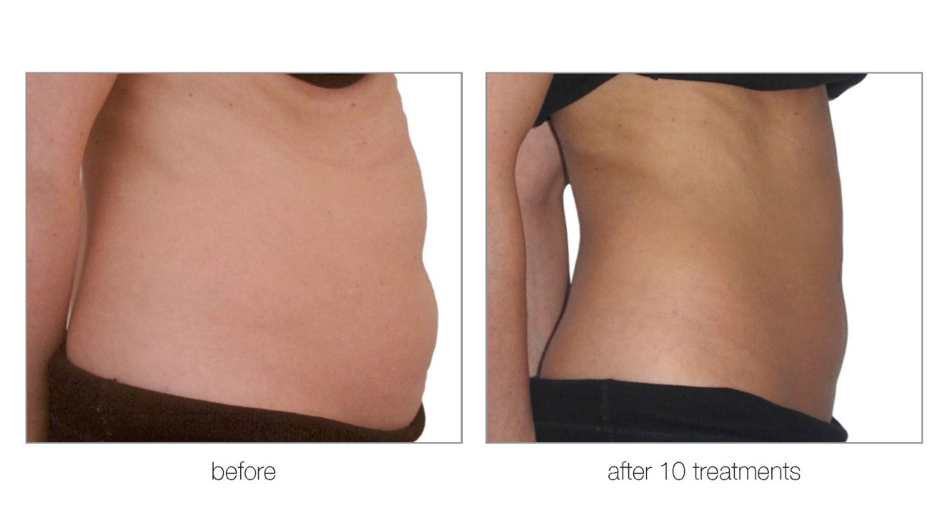 venus legacy before and after tummy