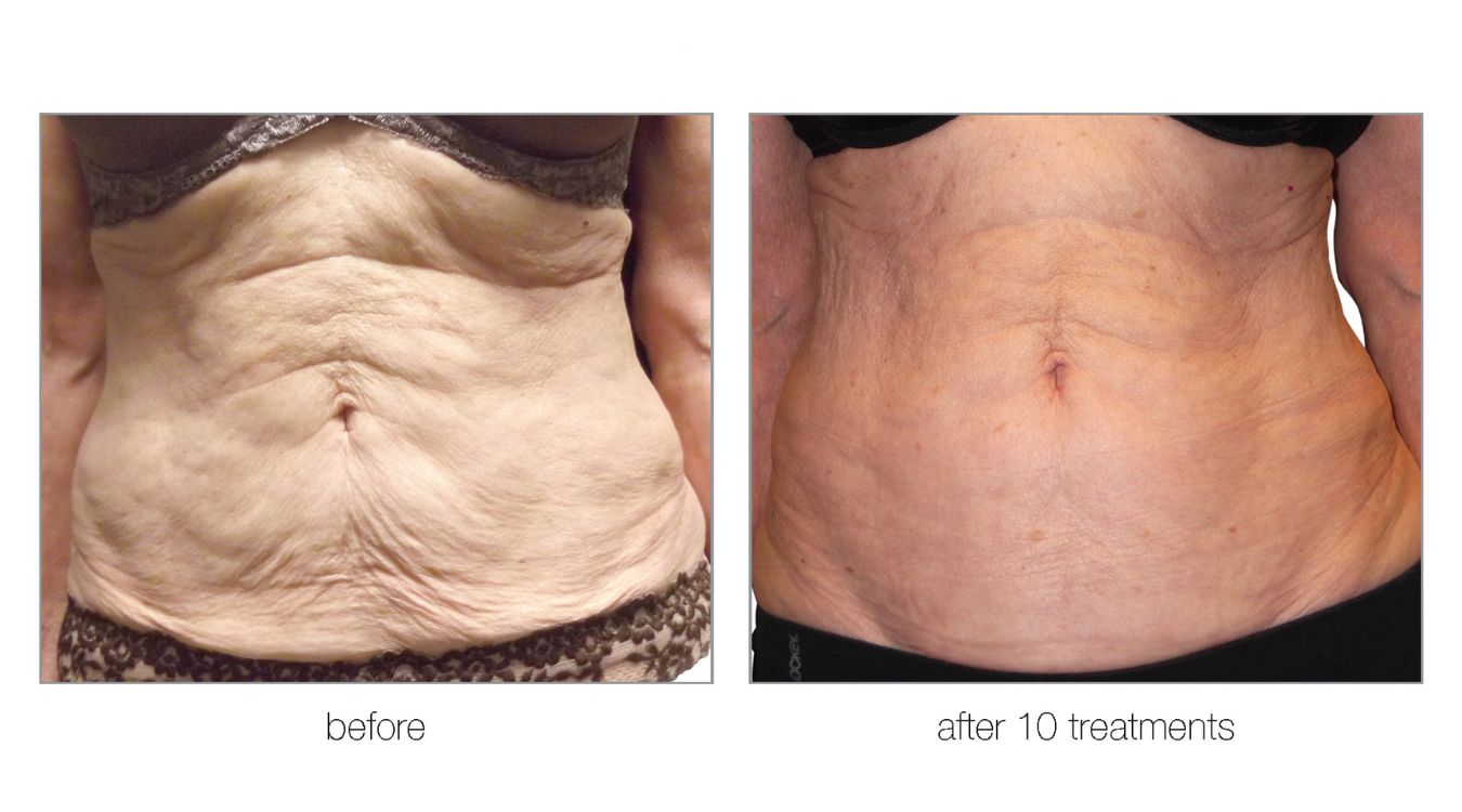 venus legacy before and after10