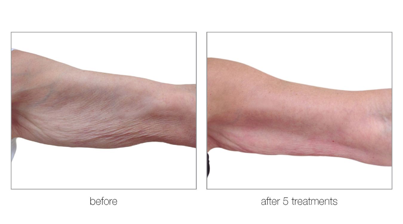 venus legacy before and after12