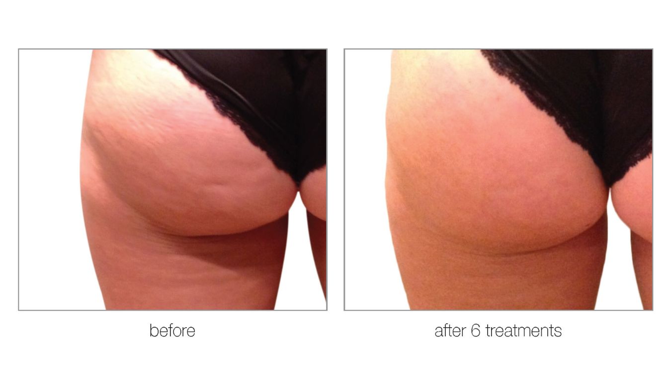 venus legacy before and after2