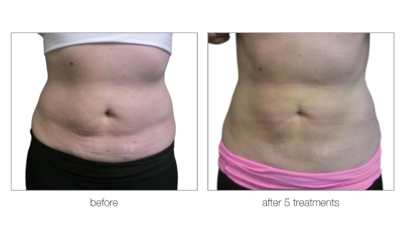 venus legacy before and after3