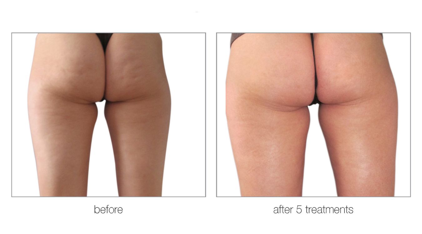 venus legacy before and after5