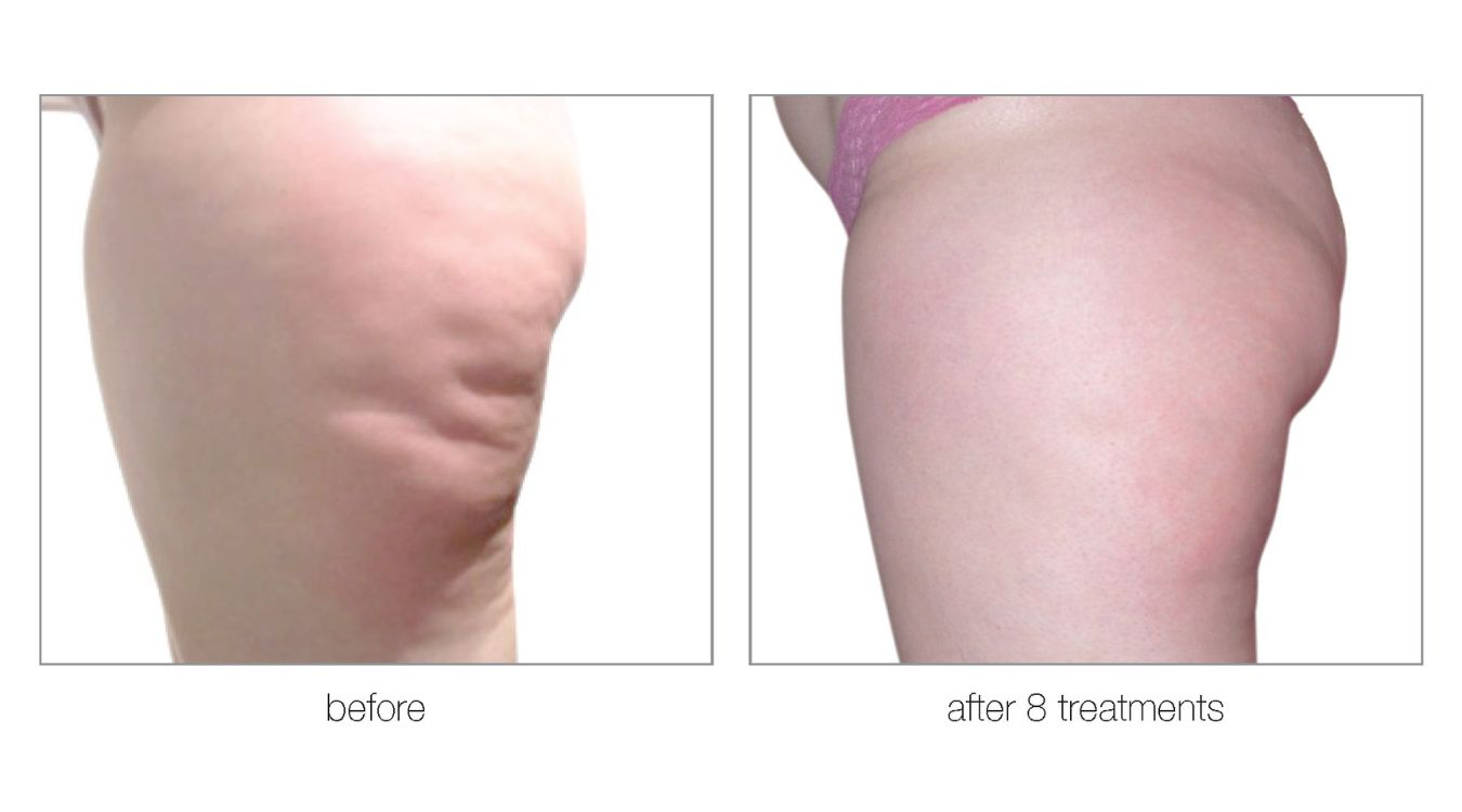 Venus legacy before and after cellulite reduction