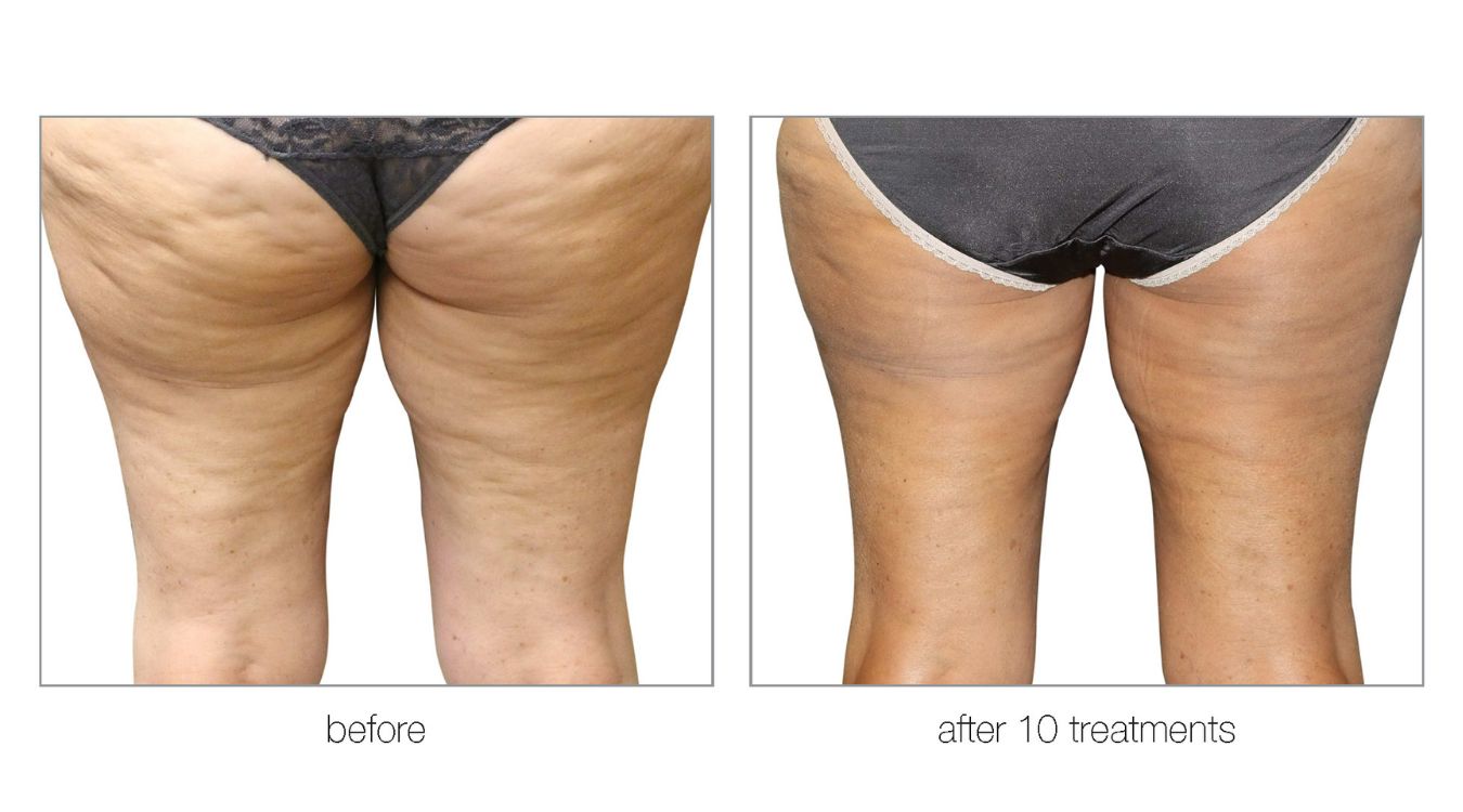 venus legacy before and after7