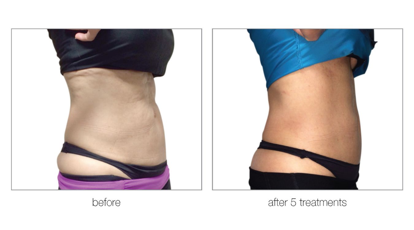 venus legacy before and after8