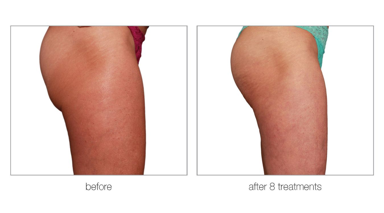 venus legacy before and after9